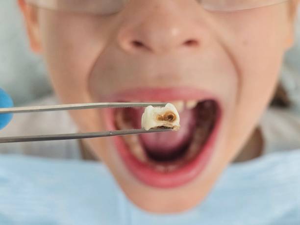 Best Emergency Dental Extractions in Whitmore Lake, MI